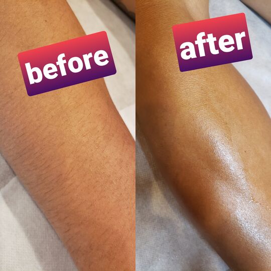 腕beforeafter