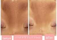 ハイドラビフォーアフター画像