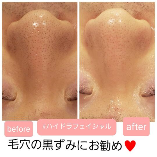 ハイドラビフォーアフター画像