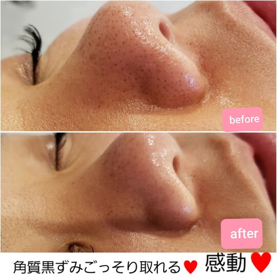 ハイドラビフォーアフター