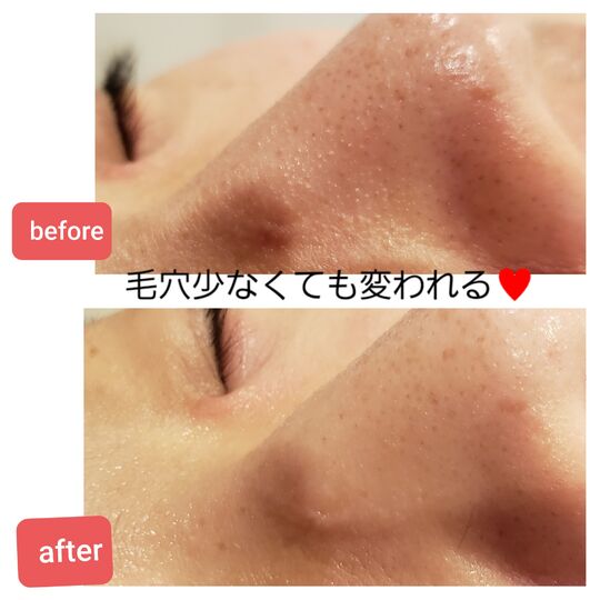 ハイドラフェイシャルビフォーアフター