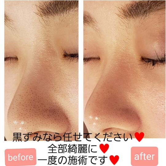 ハイドラ画像」